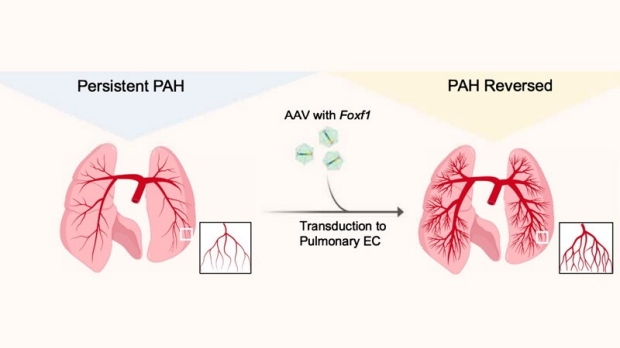 Restoring Foxf1 to lung endothelial cells of subjects with PAH by way of adeno-associated virus (AAV) reverses Pulmonary Arterial Hypertension (PAH).