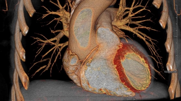 MRI of a heart