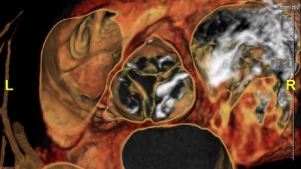 MRI of heart valves