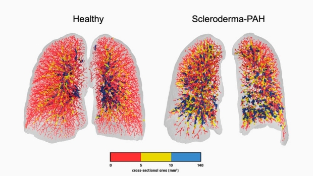 graphic of healthy versus scleroderma-PAH lungs