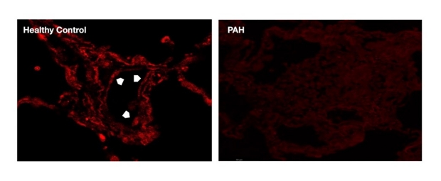 Wnt7a expression is six fold higher in healthy control vascular cells than in cells from individuals with pulmonary arterial hypertension (PAH)