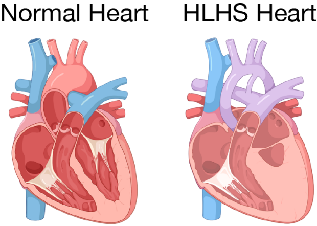 illustration of normal heart and one with hypoplastic left heart syndrome
