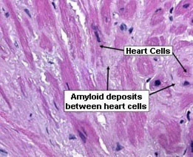 photo of amyloid deposits between heart cells