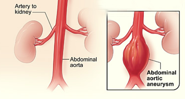 medical illustration of normal artery and one with an abdominal aortic aneurysm
