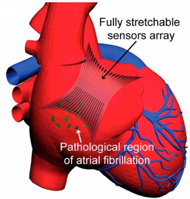 illustration of fully stretchable elastrode array attached to a human heart