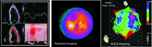 graphic of perfusion imaging and NOGA mapping