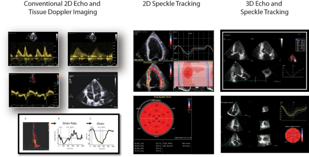 graphics of conventional 2D echo and tissue doppler imaging, 2D speckle tracking, and 3D echo and speckle tracking