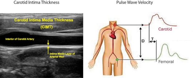 ultrasound of carotid intima thickness and graphic of pulse wave velocity
